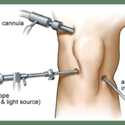 arthroscopy