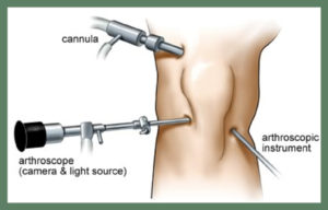 arthroscopy