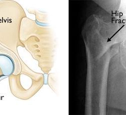 hip joint fracture