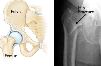 hip joint fracture