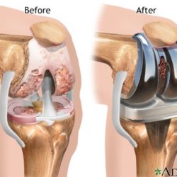 KNEE REPLACEMENT