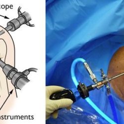 Shoulder Arthroscopy