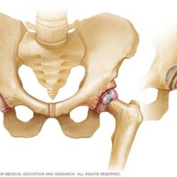 Hip Replacement