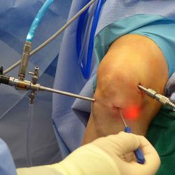 knee arthroscopy